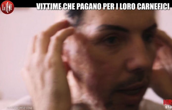 william-pezzullo-sfregiato-le-iene William Pezzullo, Ragazzo Sfregiato con Acido a Le Iene: Servizio 26 marzo 2017